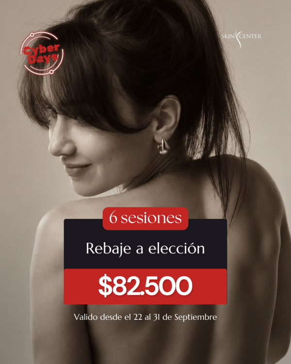 Depilación Láser - 6 Sesiones de Rebaje Completo