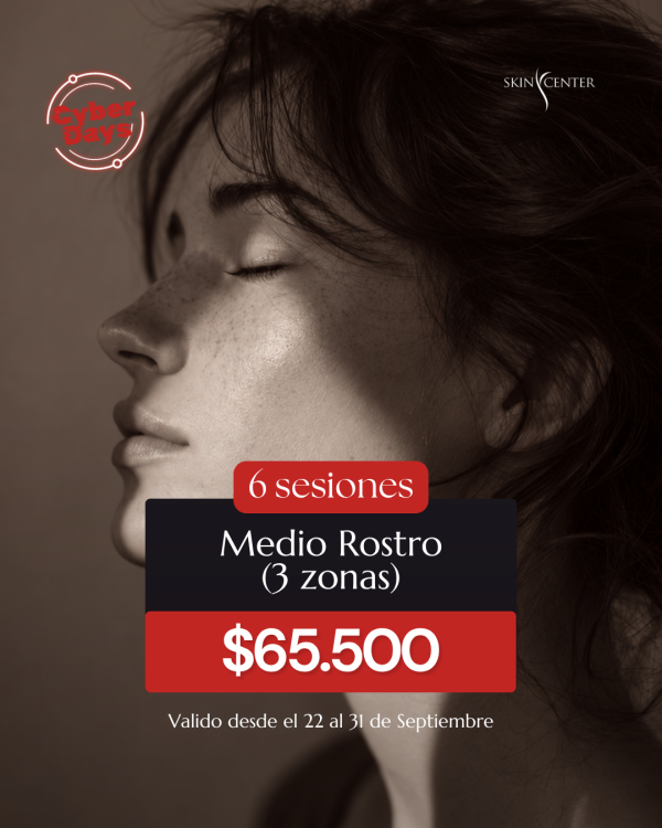 Depilación Láser - 6 Sesiones de Medio Rostro (3 zonas)